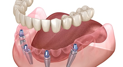 Rendering of implant dentures in lower arch